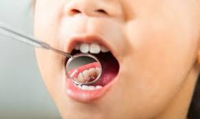 What Causes Cavities in Children?